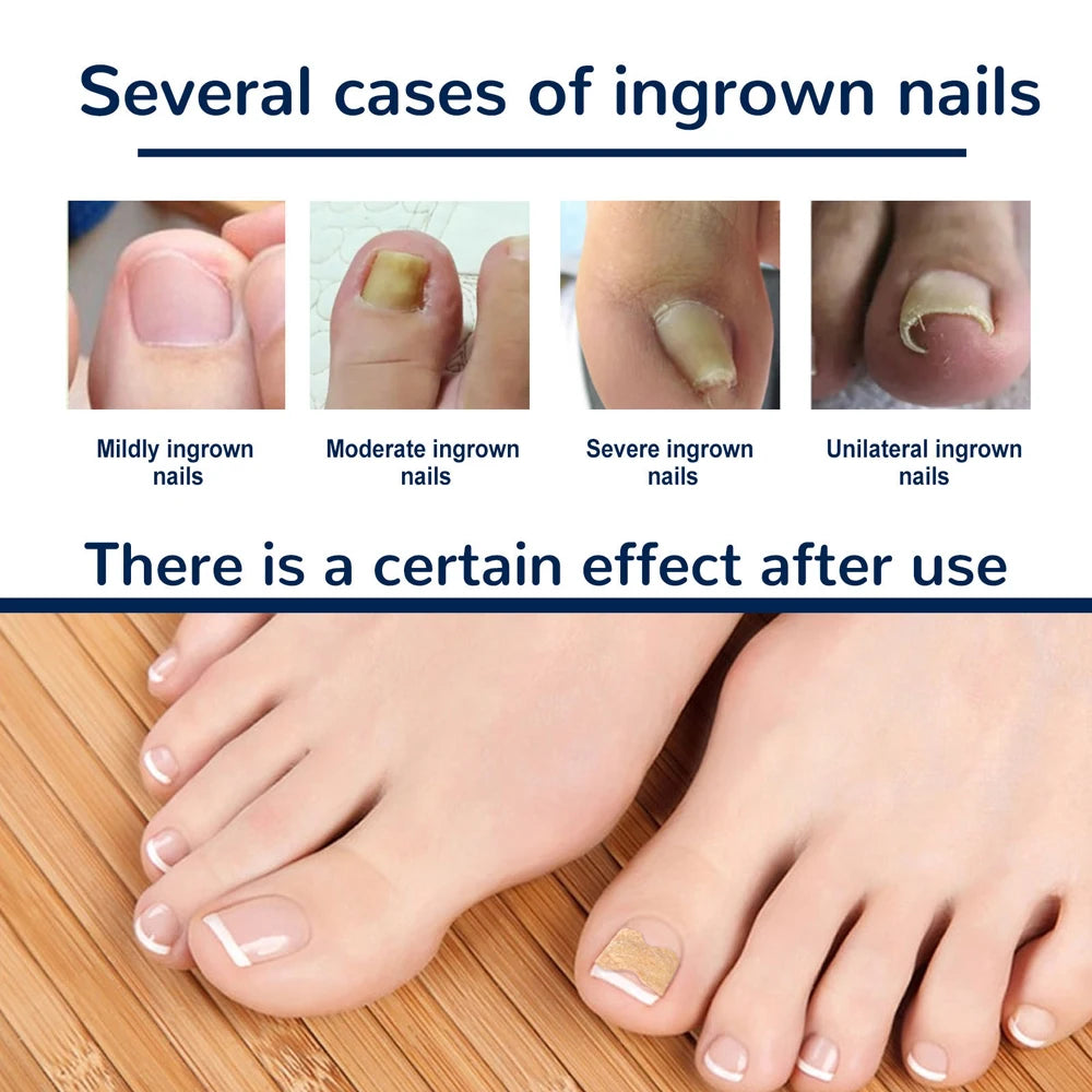 Designed for use on both fingernails and toenails for versatile correction and care.